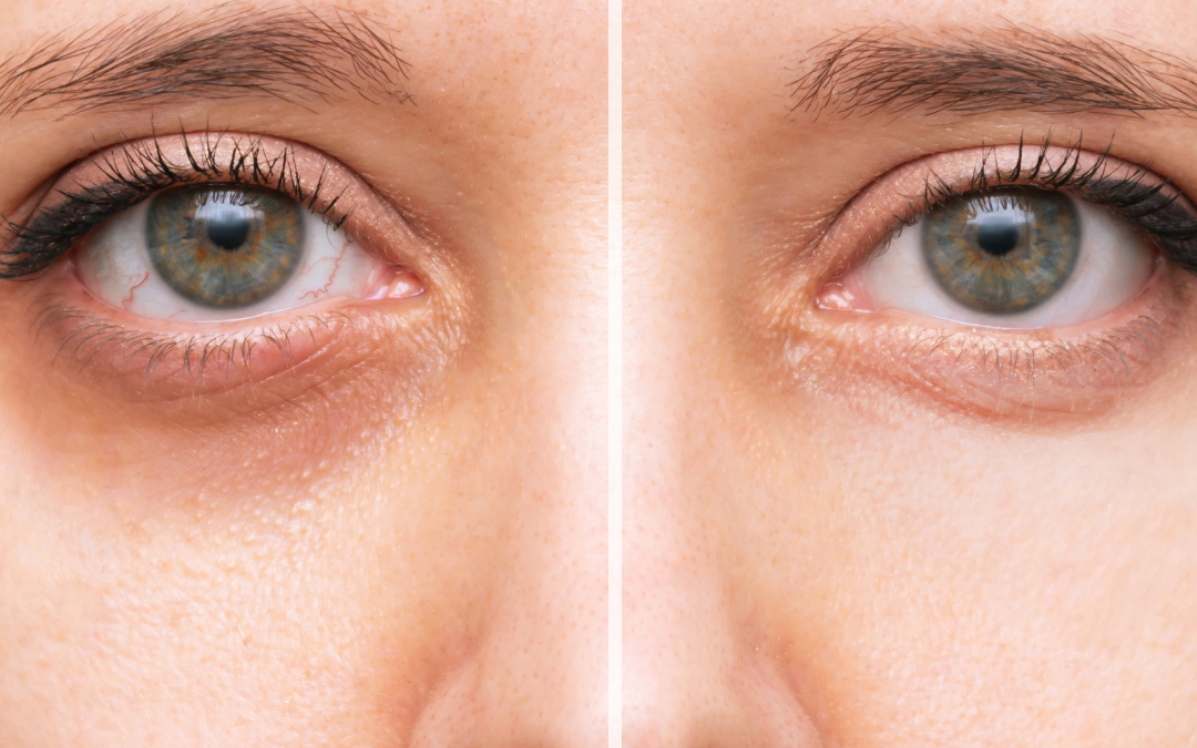 Brightening Your Look: Is Microneedling Safe Under the Eyes?