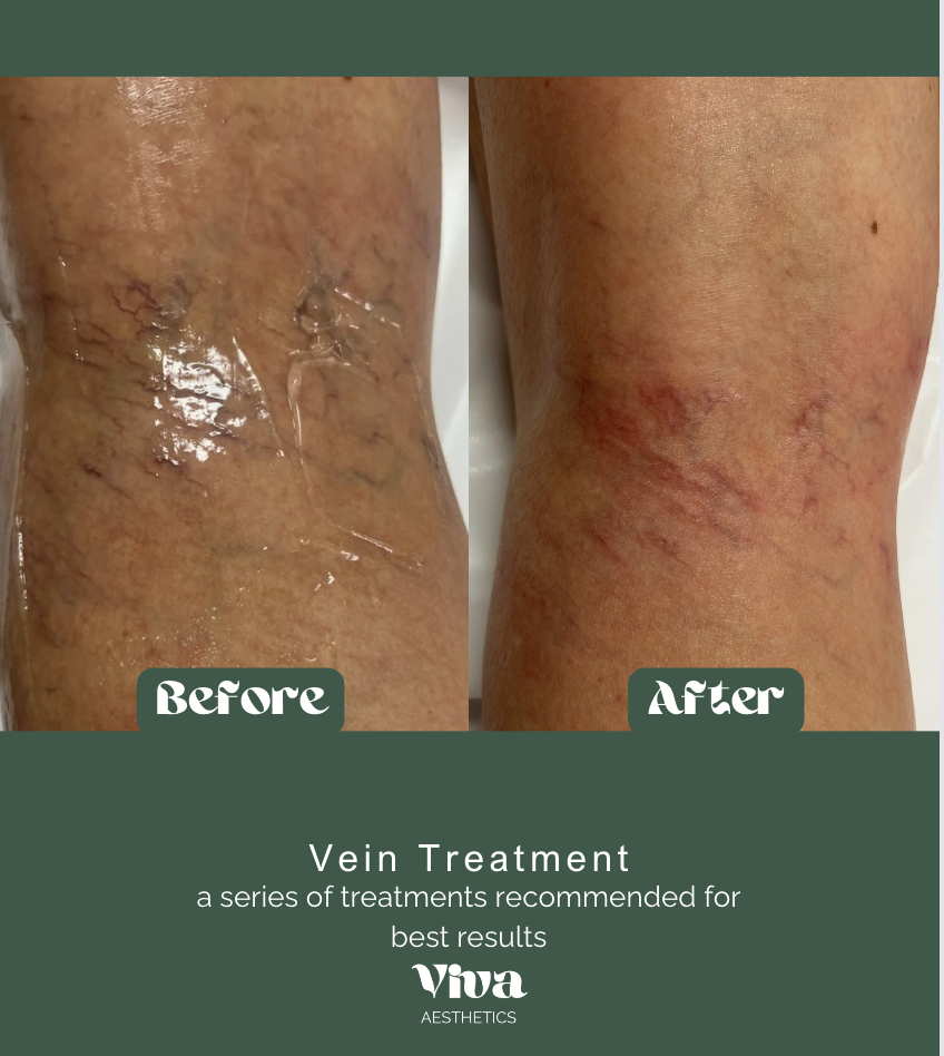 leg veins before and after at viva aesthetics